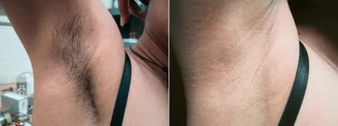 Фотоэпиляция подмышек фото до и после